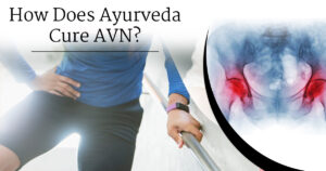 Read more about the article Role of Ayurveda in the Conservative Management of AVN( Avascular Necrosis)
