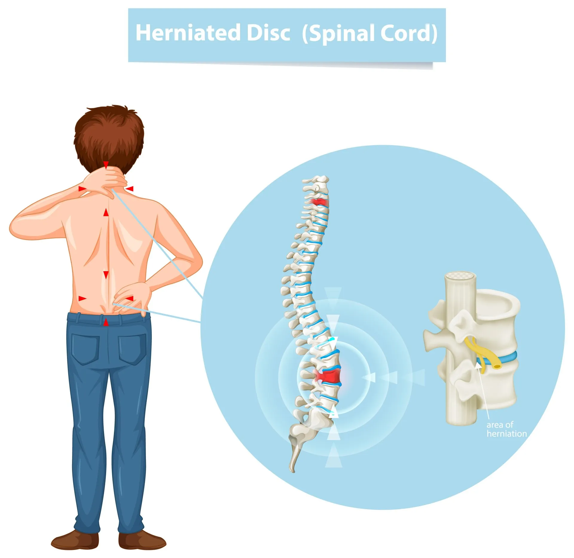 Read more about the article Slip Discs Explained: Causes, Symptoms, and Treatments